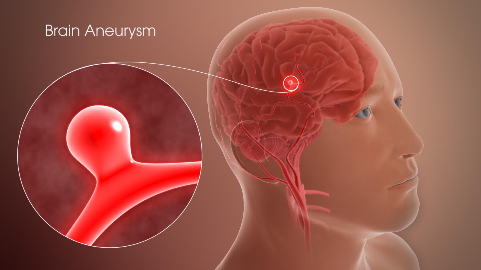 Ruptured brain aneurysm showing bleeding in the brain requiring emergency medical treatment