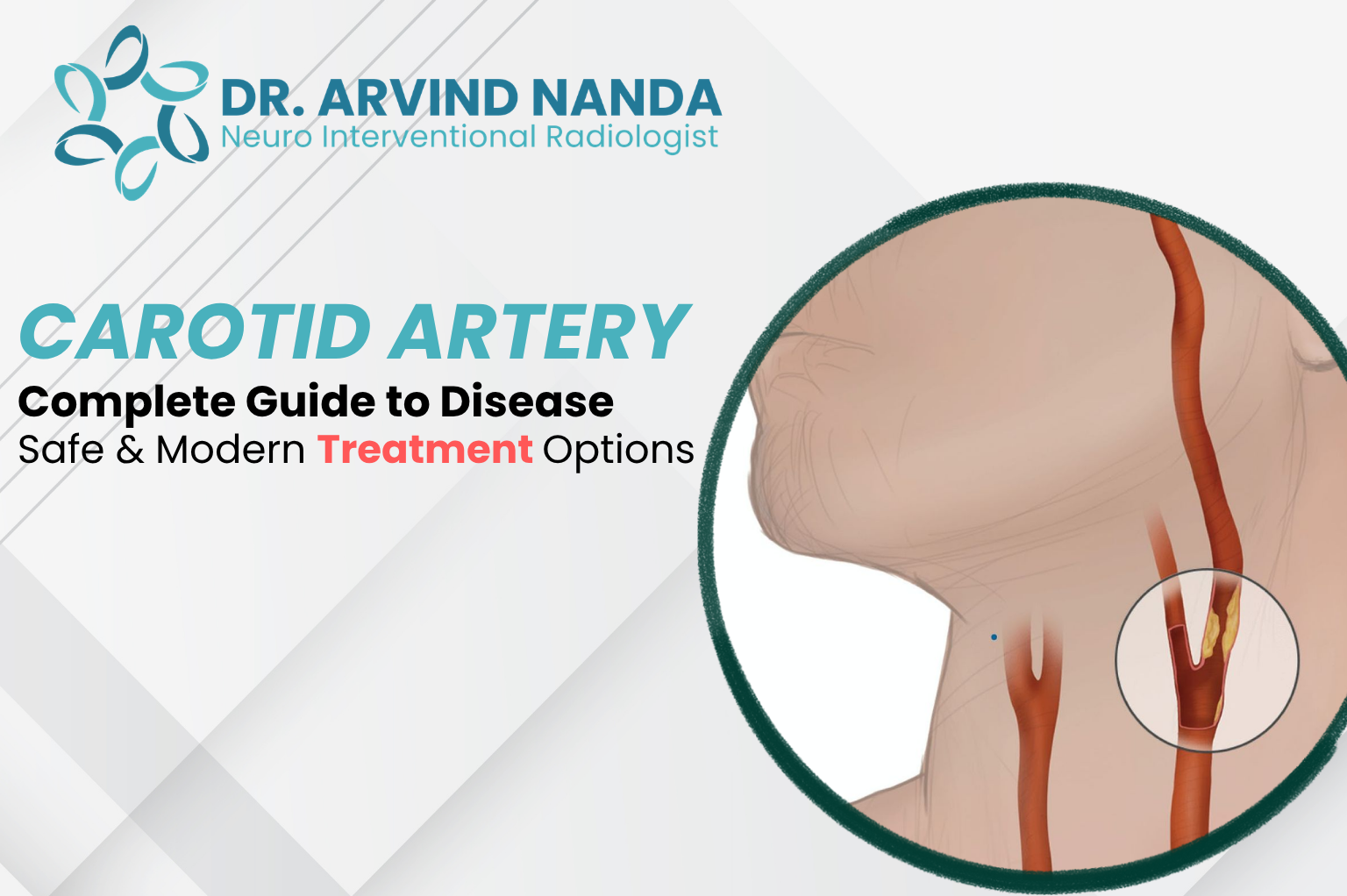 Dr Arvind Nanda providing Carotid Artery Treatment in Faridabad for carotid blockage and stroke prevention care