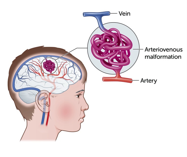 Arteriovenous Malformations