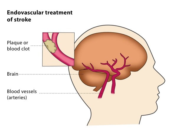 Endovascular Treatment for Acute Ischemic Stroke
