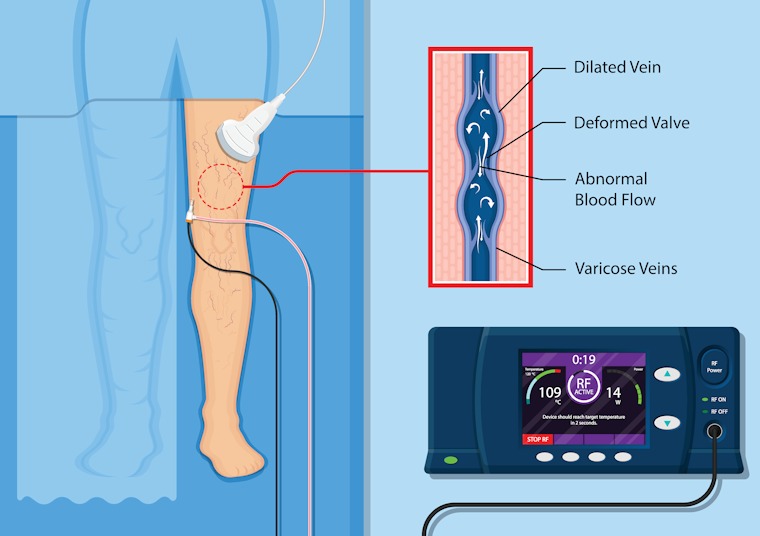 RFA treatment of varicose veins