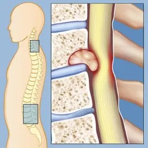 Spinal Cord Tumor