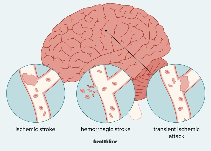Symptoms of brain stroke